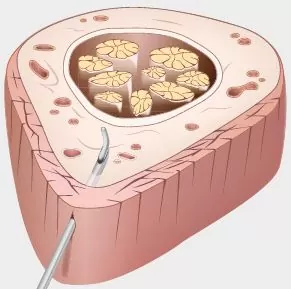 Epidurālā anestēzija